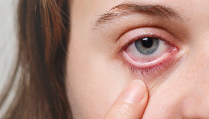 Conjunctivitis, conjunctivitis causes, conjunctivitis during monsoon, conjunctivitis symptoms, conjunctivitis prevention, conjunctivitis prevention measures, pink eye,