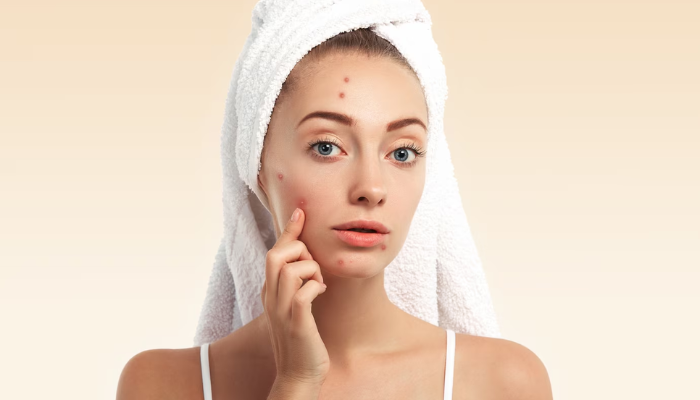 pimples after a cleanup, pimples after cleanup, Post-cleanup breakouts, Post-cleanup pimples, Acne after cleanup, post-cleanup pimples,