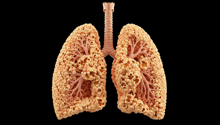 Popcorn lungs, Bronchiolitis Obliterans, popcorn lungs meaning, popcorn lungs symptoms, popcorn lung vaping, popcorn lung treatment,